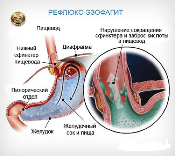 заболевание рефлюкс-эзофагит