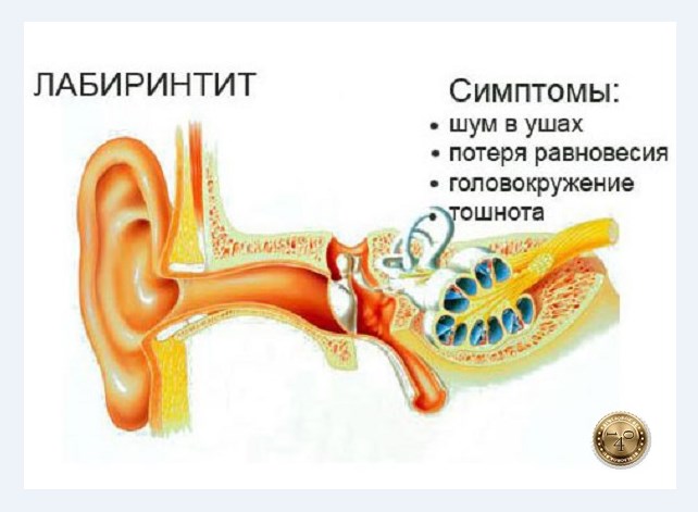 симптомы лабиринтита