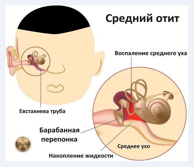 воспаление среднего уха