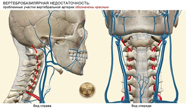 вертубробазелярная недостаточность