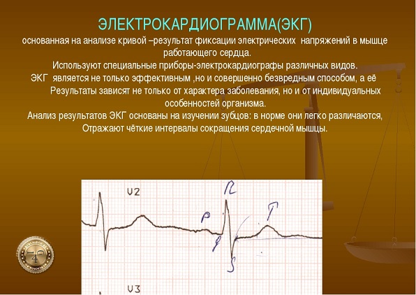 экг