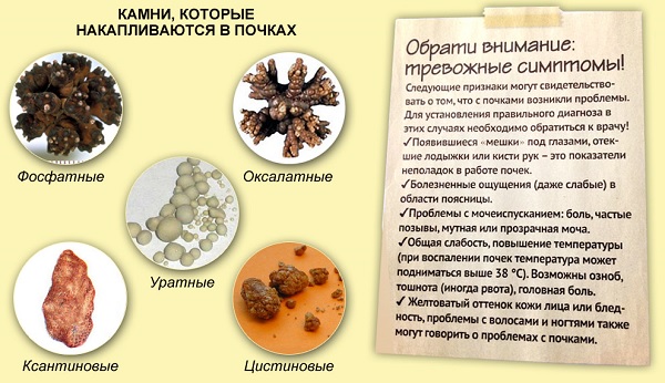 уратные камни в почках