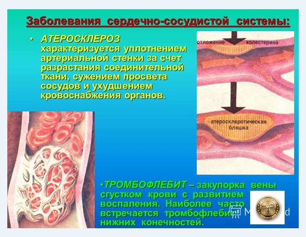 тромбофлебит