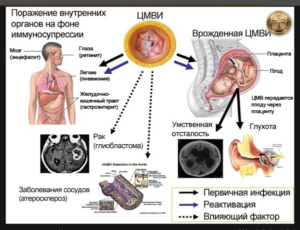 на что влияет цитомегаловирус