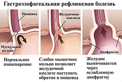 газофагельный рефлюкс