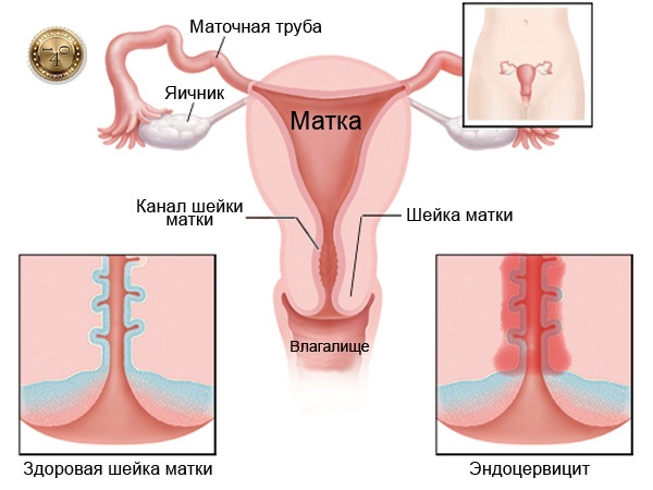 заболевание эндоцервицит