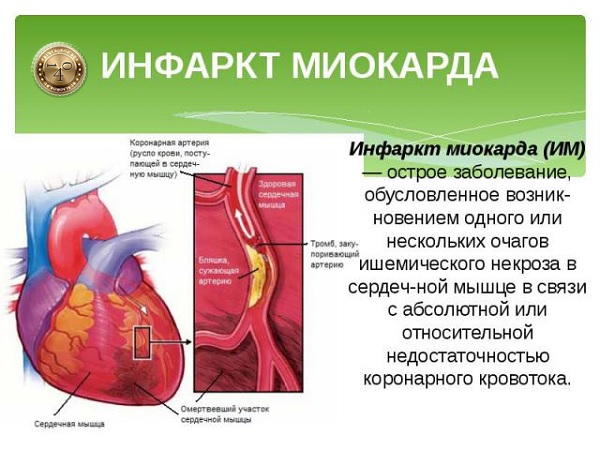 инфаркт миокарда
