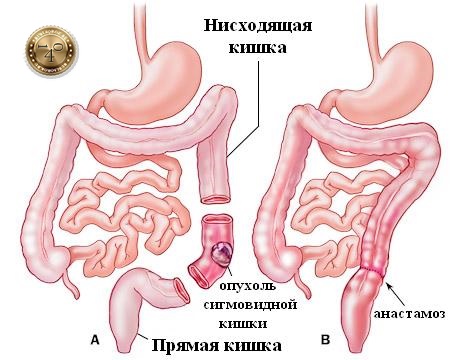 заболевание сигмоидит