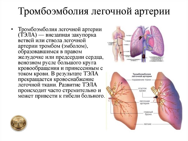 заболевание тромбоэмболия