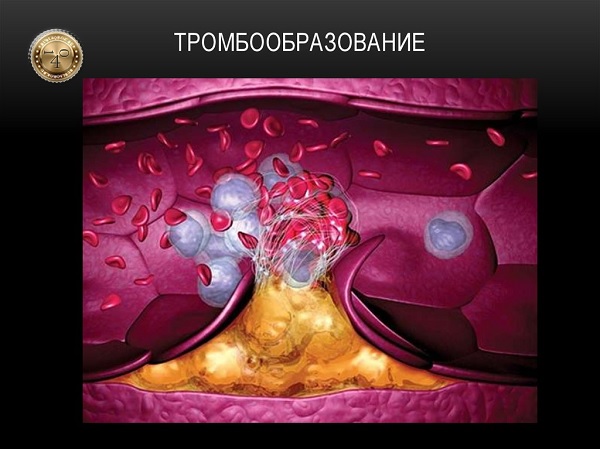 тромбообразование