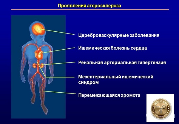 проявления атеросклероза