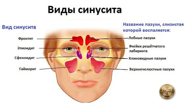 заболевание синусит