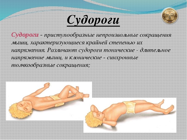 виды судорог