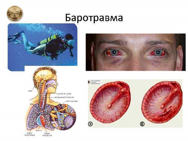 последствия баротравмы