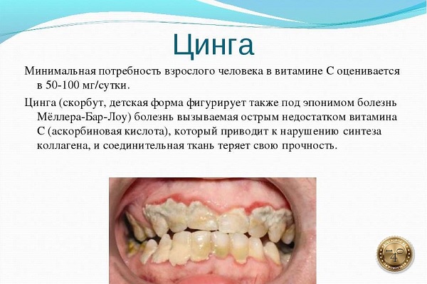 что такое цинга 