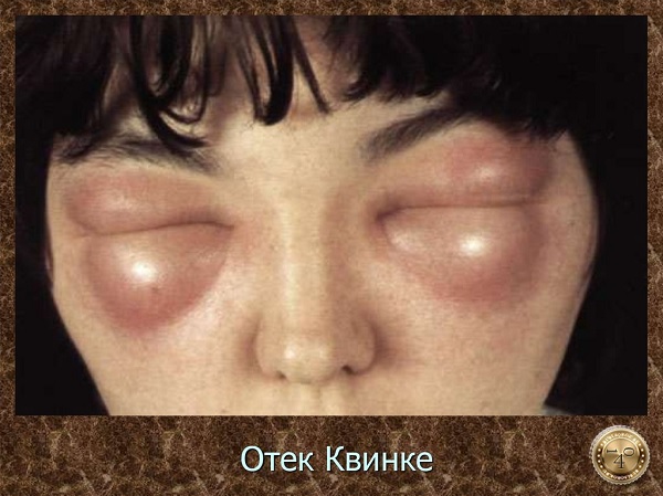 отек Квинке