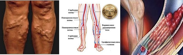 тромбофлебит вен
