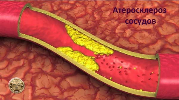 бляшки в сосудах