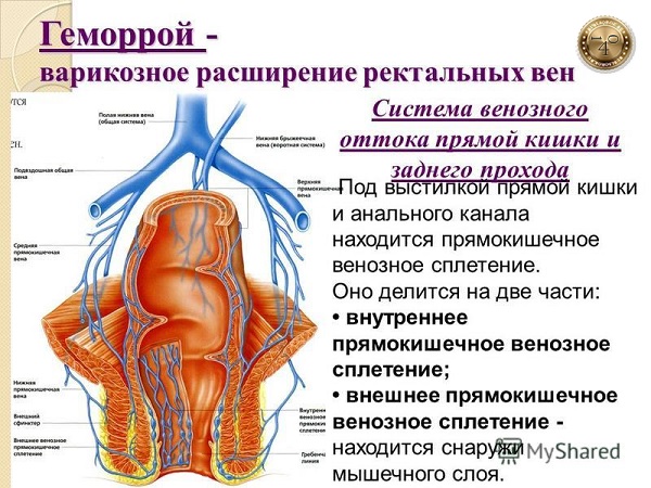 геморрой