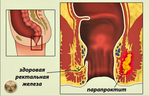 парапроктит