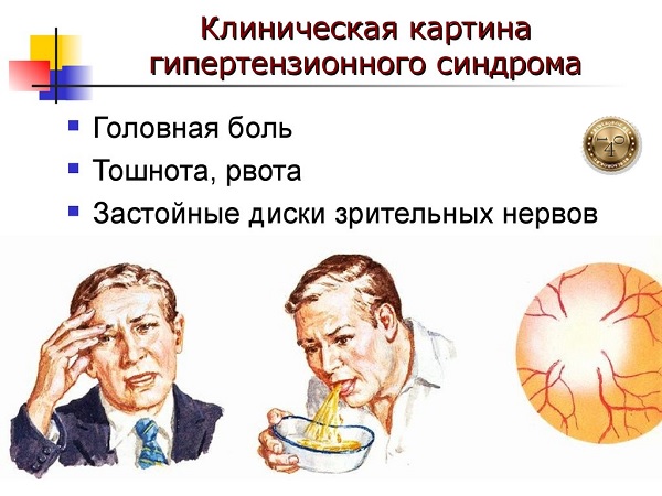 внутричерепная гипертензия