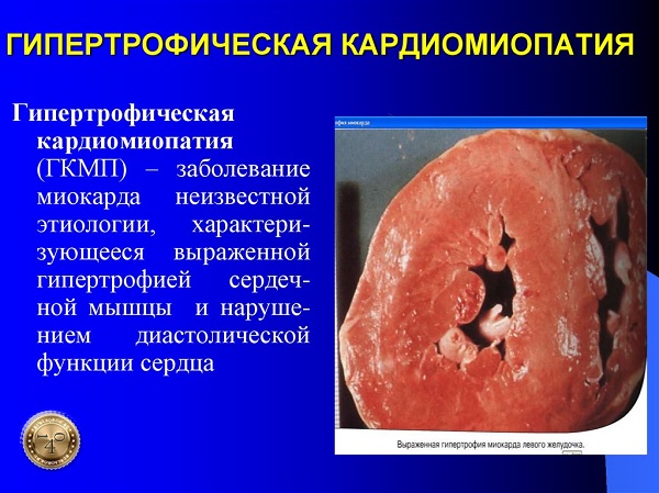 гипертрофическая кардиомиотропия