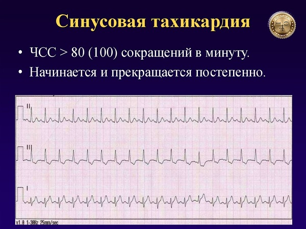 синусовая тахикардия